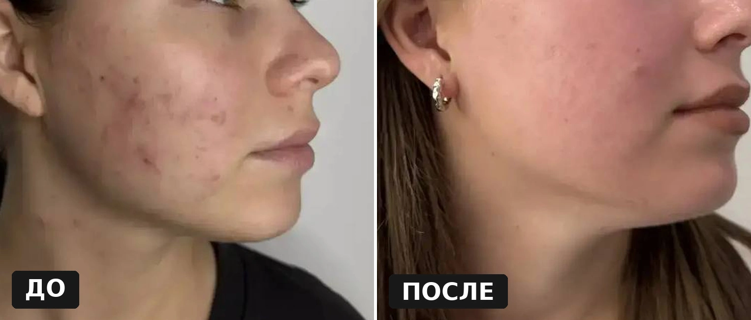Результат лечения постакне: до и после